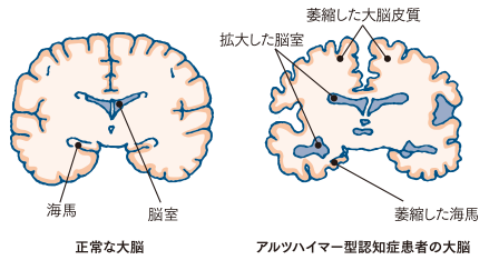 健康な人の大脳とアルツハイマー型認知症患者の大脳